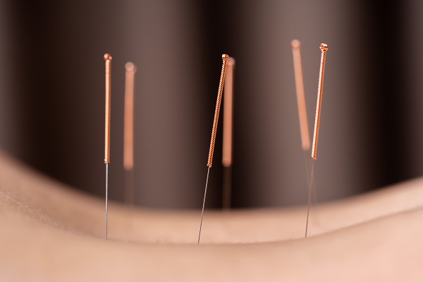 Acupuncture for Back Pain