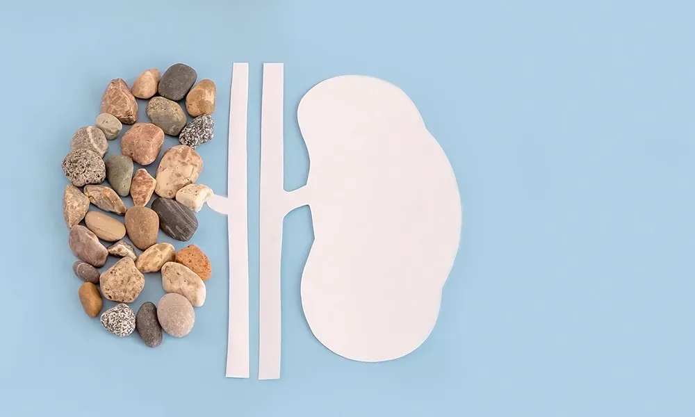 Balancing Act: Nephrologists And The Challenge Of Patient Care And Research Kidney Stones