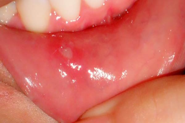 Canker Sores