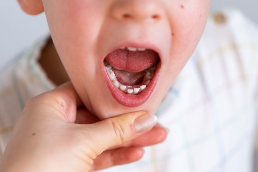 Effective Strategies for Preventing Dental Issues in Kids Dental-Issues-in-Kids