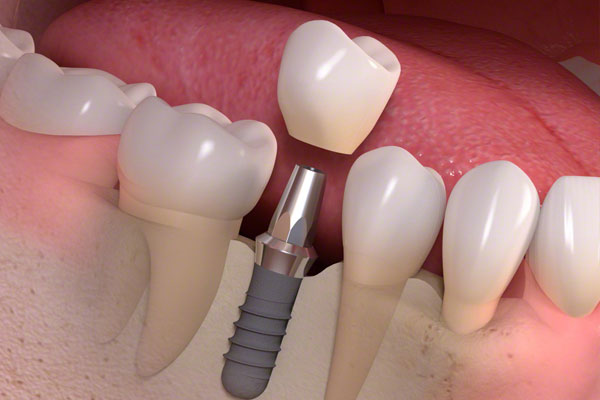 dental implants
