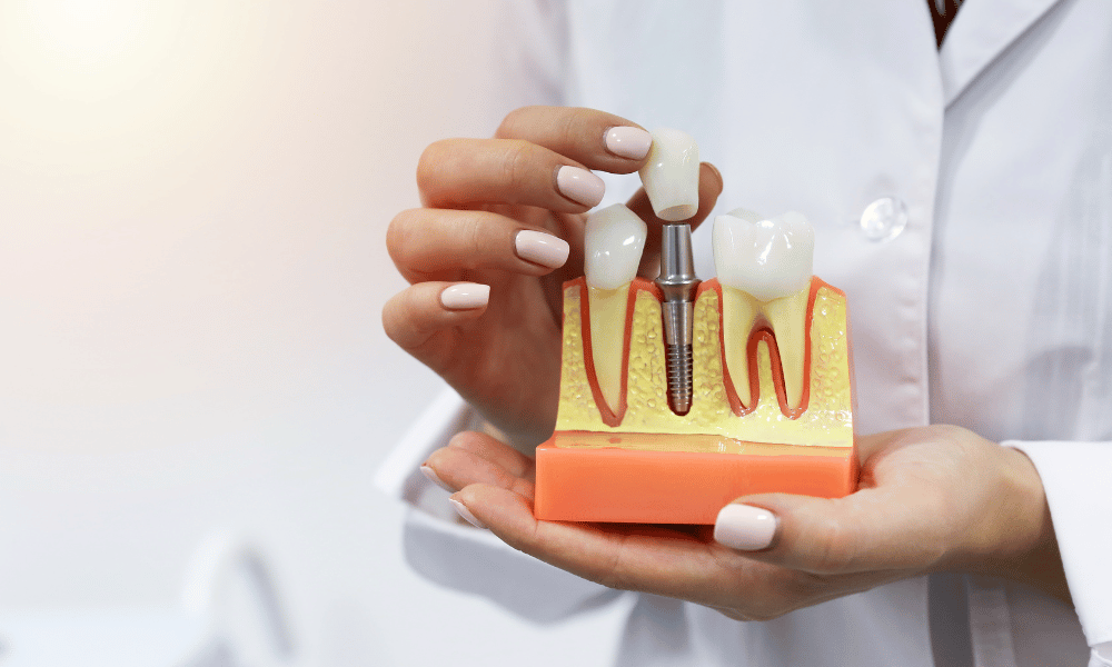 Debunking misconceptions about dental implants: Your essential guide Dental Implants