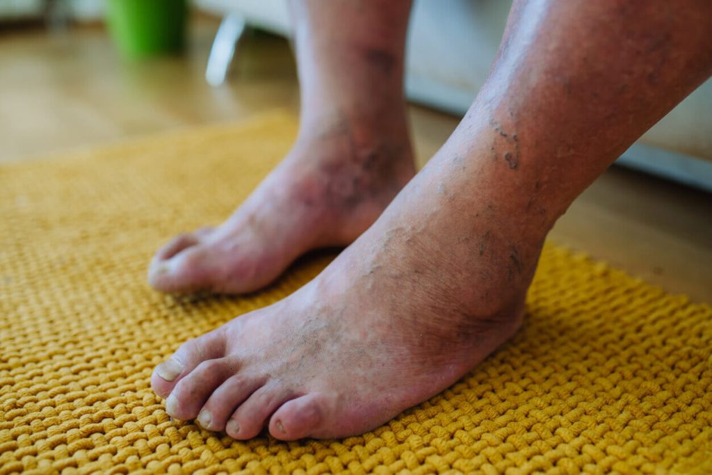 Podiatry And Diabetes: Preventing Complications