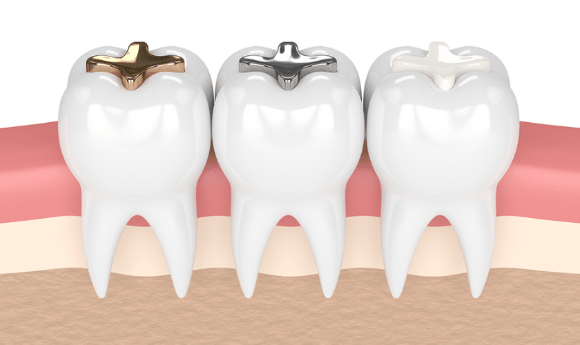 Different Types of Dental Fillings: Pros and Cons