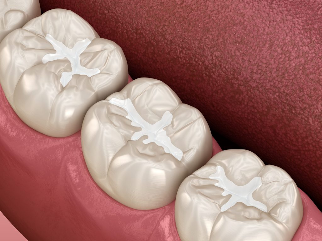Exploring The World Of Tooth-Colored Fillings