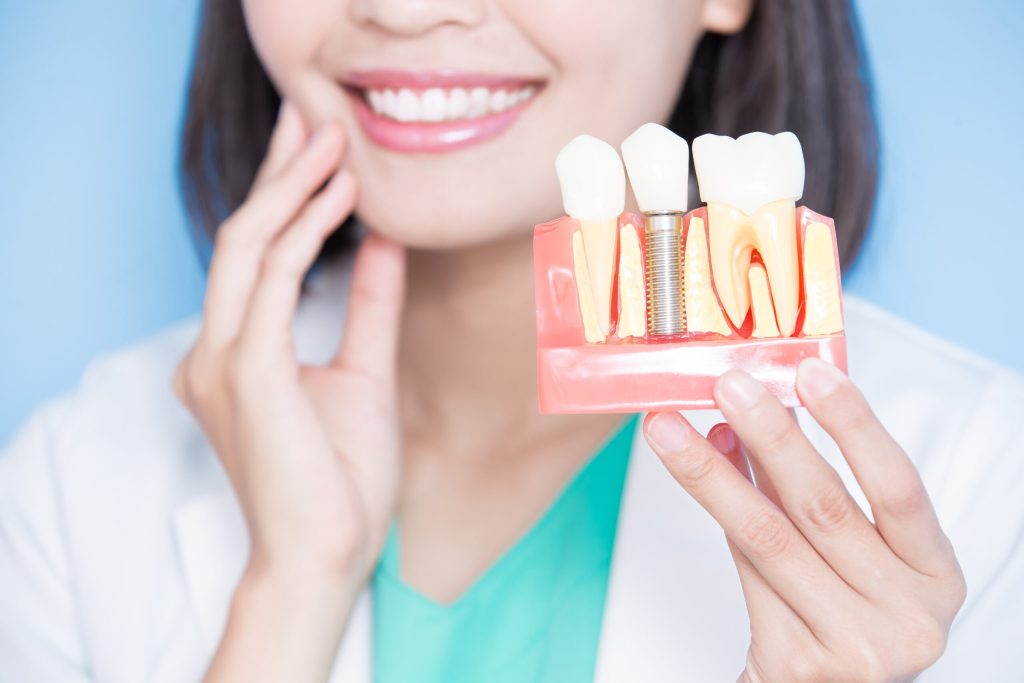 How Long Do Dental Implants Last? A Durability Overview