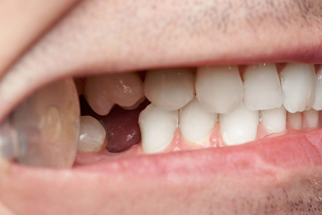 Why You Should Replace Missing Teeth in Phoenix?