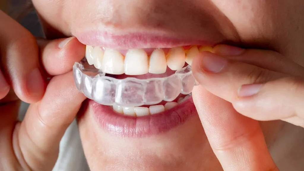 Why do adults choose Invisalign braces?