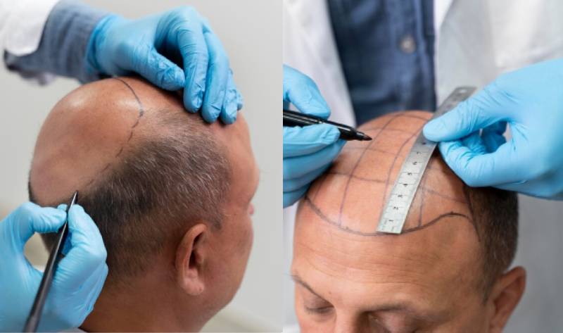FUE+FUT+BHT Hair Transplant Method: Working Process & Effectiveness
