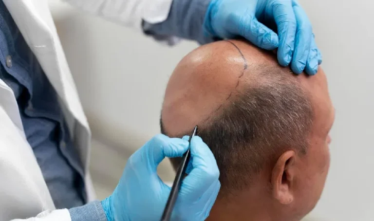 Real Results: What to Expect from a Hair Transplant in Dubai