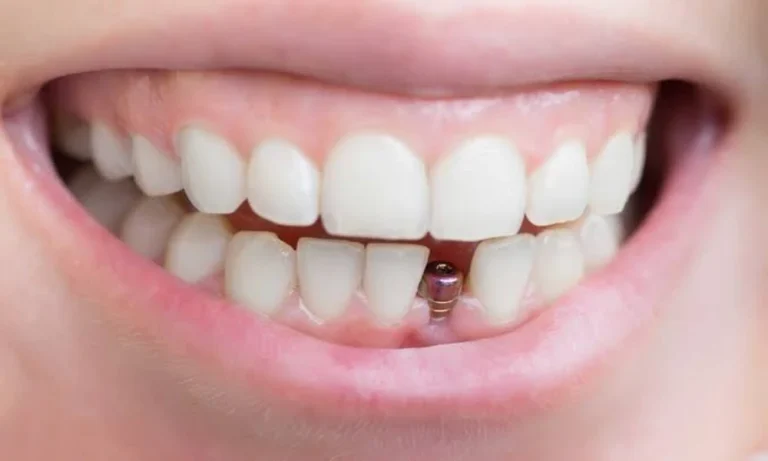 How Long Does It Take to Get Dental Implants?